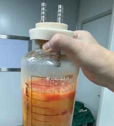 洛阳水动力吸脂手术要做多久？